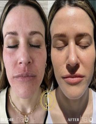 Halo Laser Skin Resurfacing